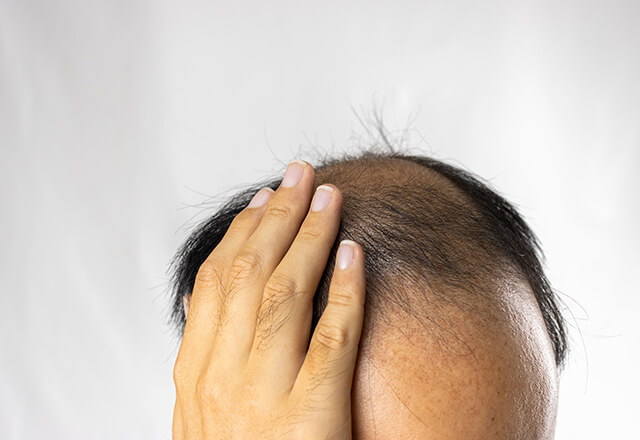 男性型脱毛症(AGA)